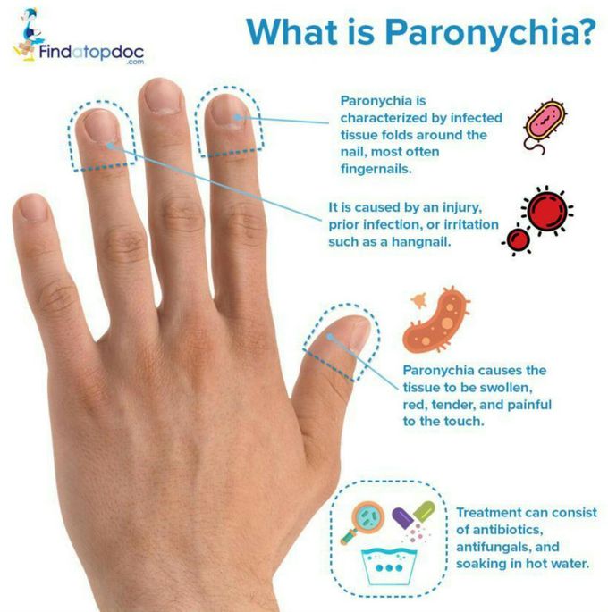 Do you know what is paronychia?? - MEDizzy