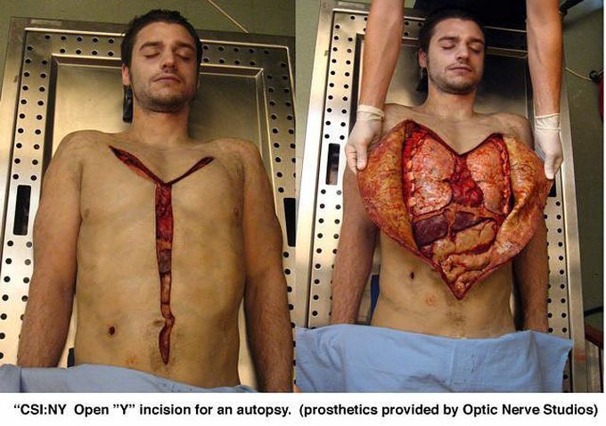 Simulated Y-incision