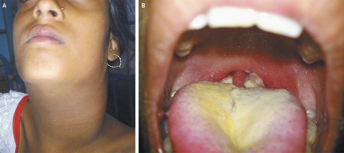 Respiratory Diphtheria