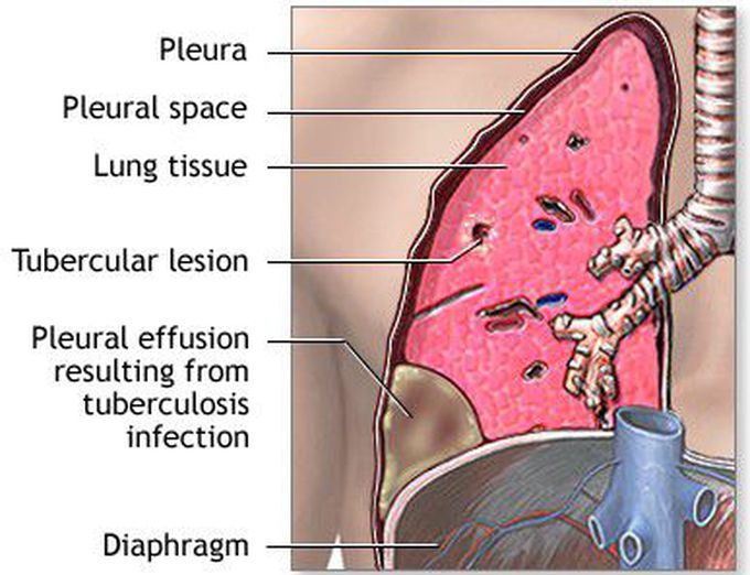 Pleural Tuberculosis