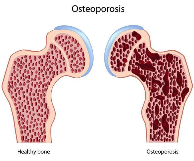 Healthy bone vs Osteoporosis Affected Bone