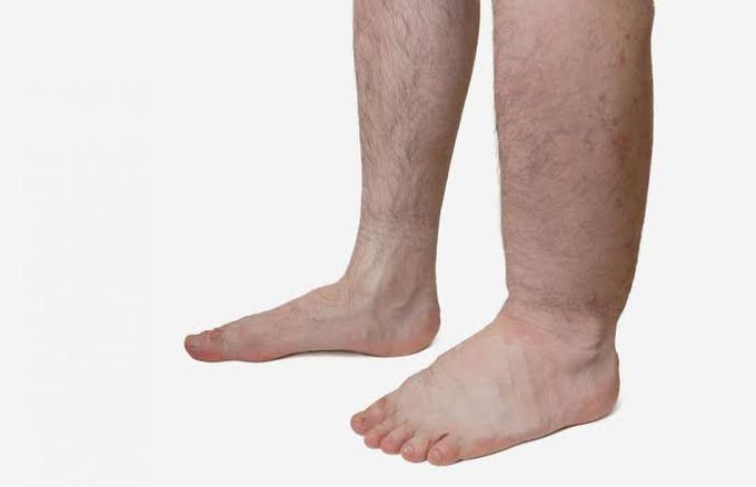 Local causes of edema