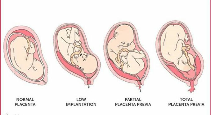 Types of placenta previa!!