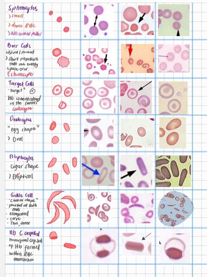 Abnormal RBCs Morphology