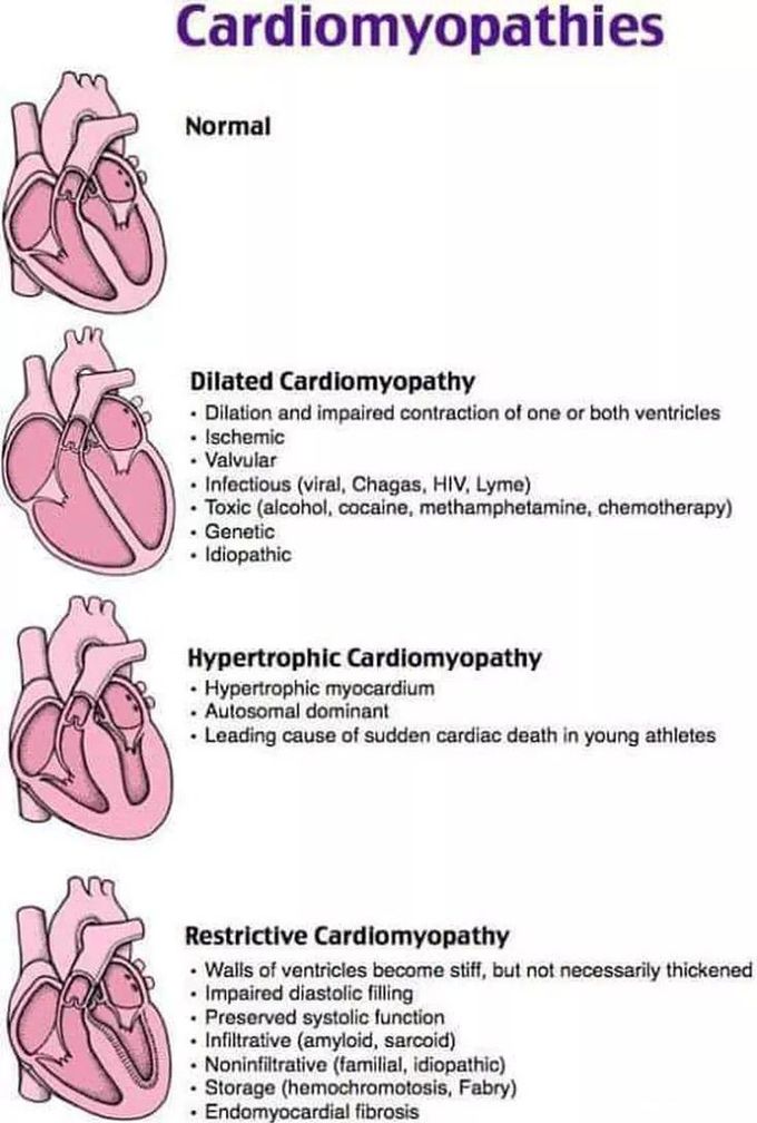 Cardiomyopathy