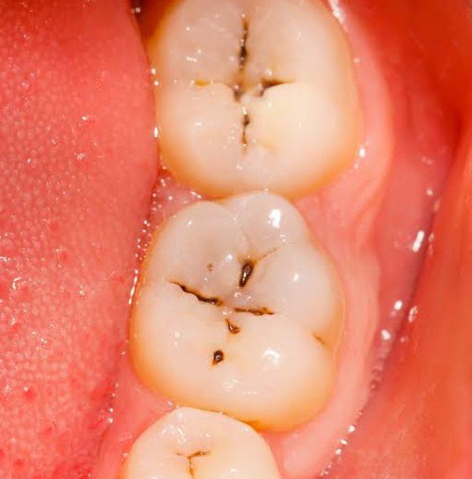 Class 1 caries (GV Black classification)