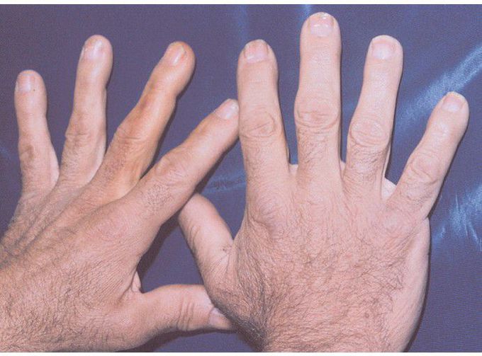 Acromegaly