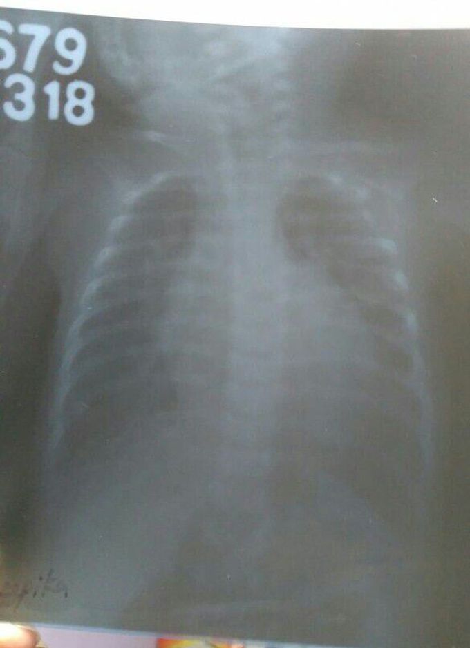 Cardiomegaly