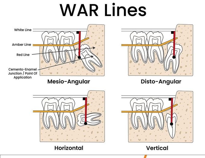 WAR Lines