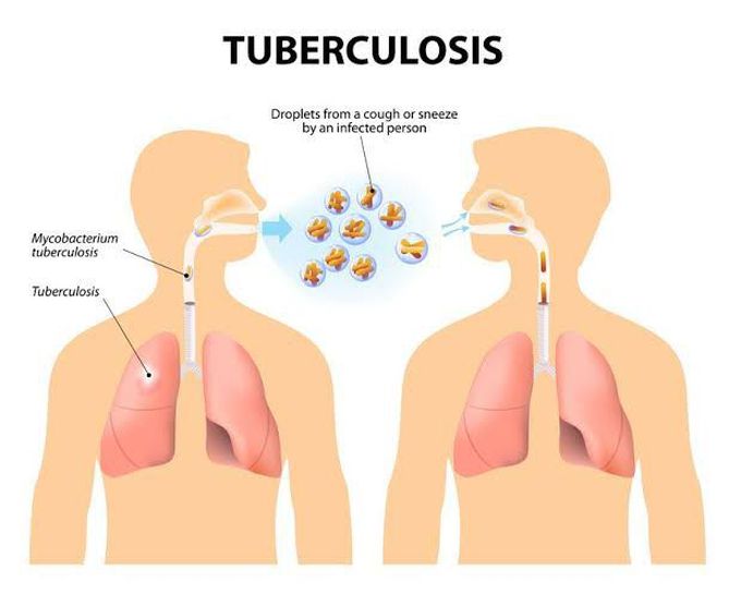 What causes TB?
