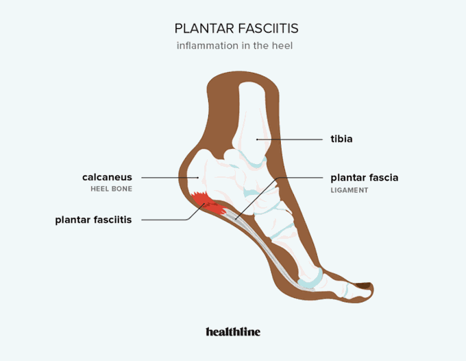 Plantar fasciitis