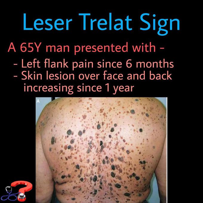 Leser-Trelat
Sign