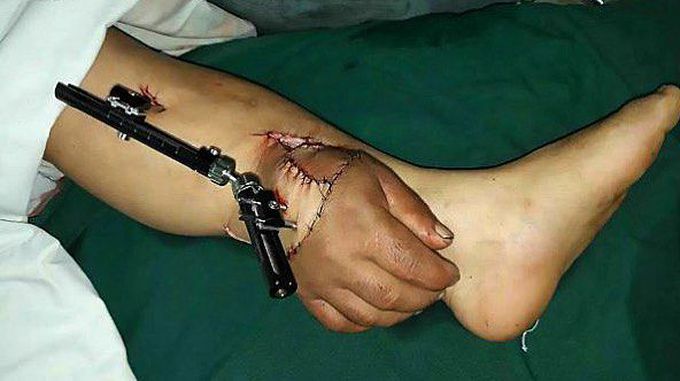 Salvaging a limb in a bizarre way!!