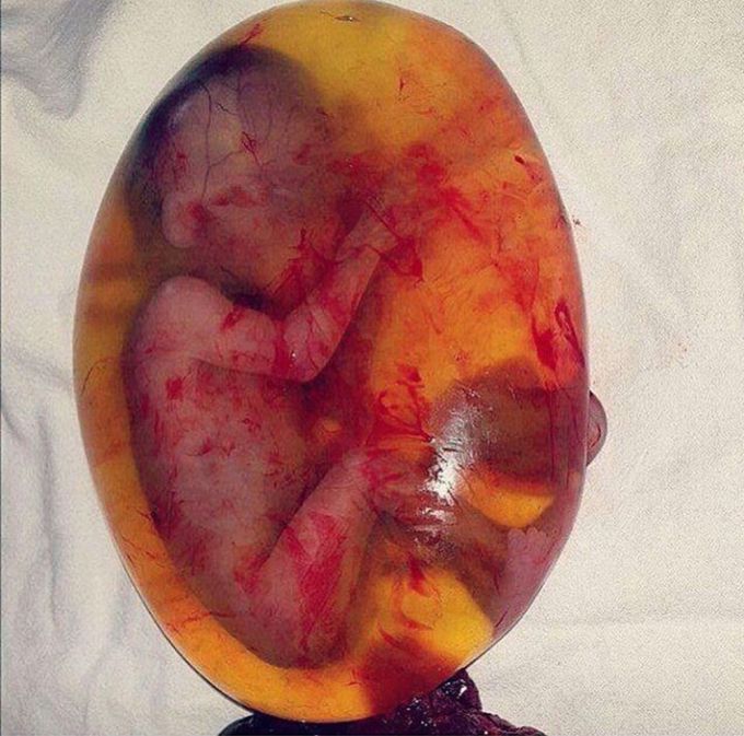 Spontaneous abortion at 18 weeks_