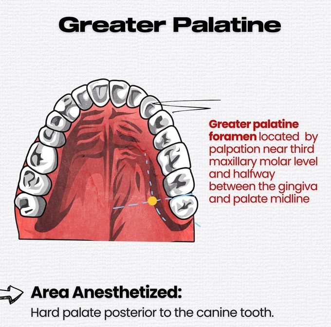 Maxillary Local Anesthesia II