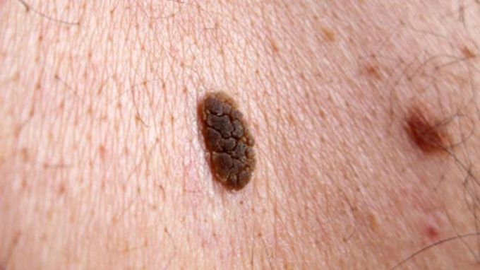 Seborrheic Keratosis with "stuck on appearance"