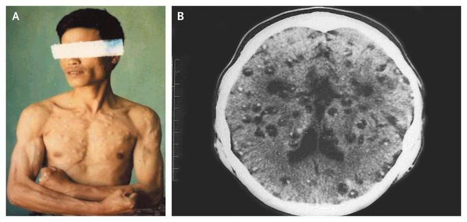 Multiple Palpable Cysts