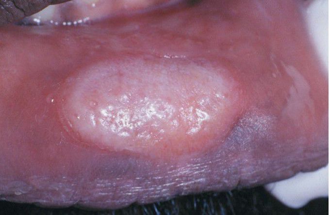 Mucous Patch of Secondary Syphilis