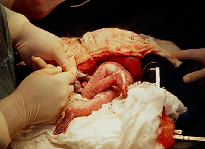 OPEN FETAL SURGERY