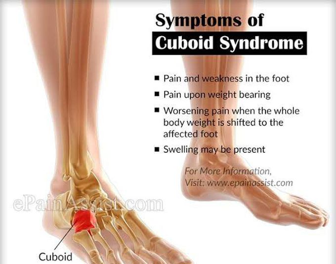 These are the symptoms of Cuboid syndrome