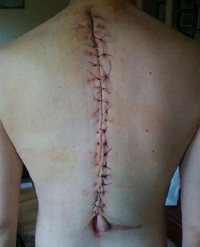 Sutures after scoliosis surgery