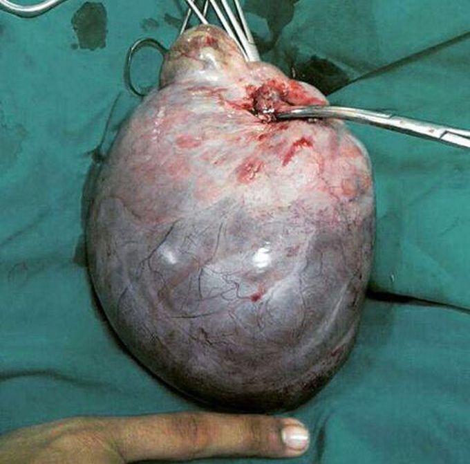 Ovarian cyst