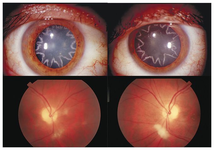 Ocular Manifestation of Electrical Burn
