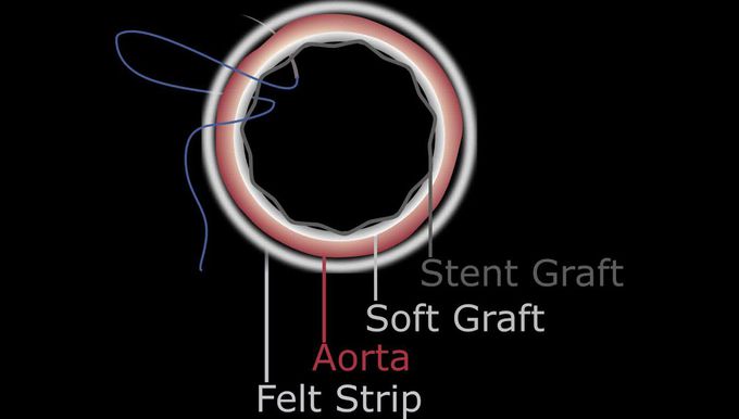 The Buffalo Trunk Technique for Aortic Arch Reconstruction