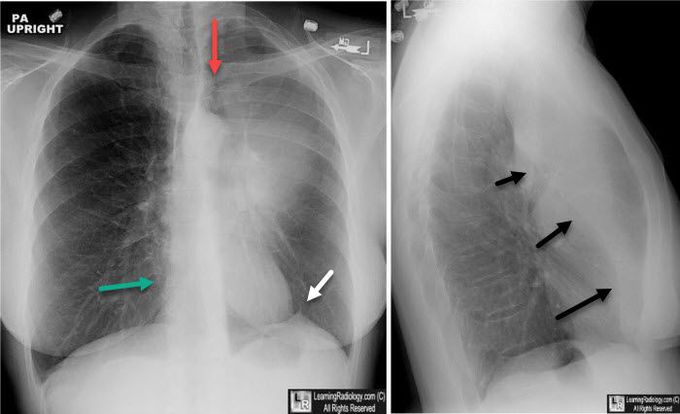 Luftsichel Sign Differential Diagnosis