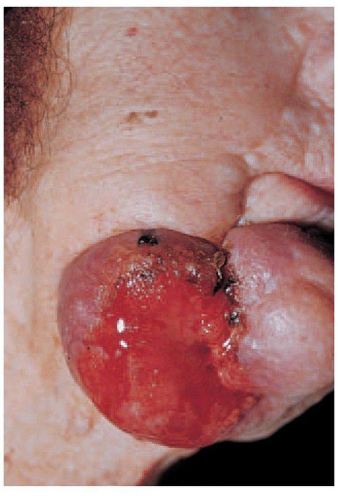 Clear cell odontogenic carcinoma