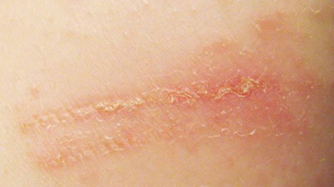 Contact dermatits