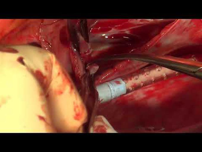 Transposition of the Great Arteries With Total Anomalous Pulmonary Venous Connection