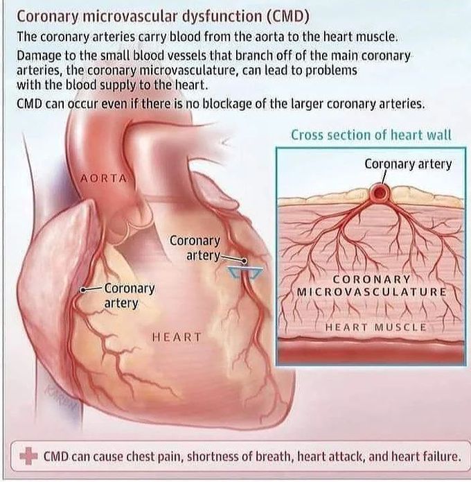Coronary microvascular dysfunction