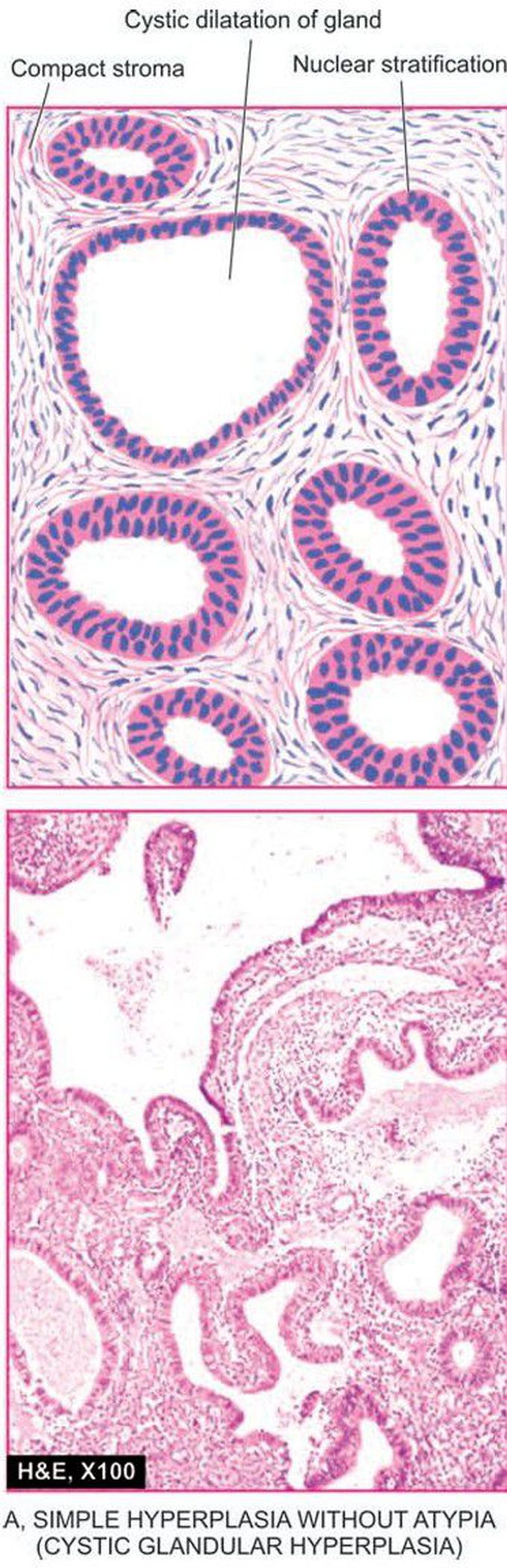 Endometrial hyperplasia