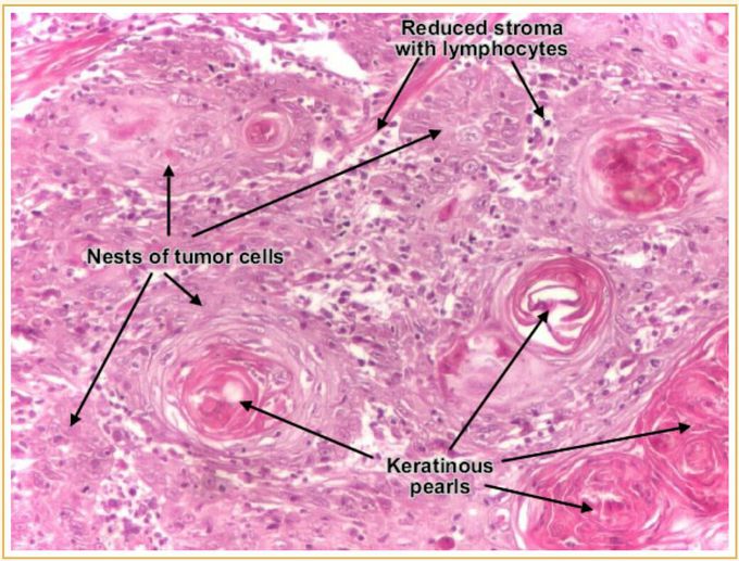 Squamous cell carcinoma of skin - MEDizzy