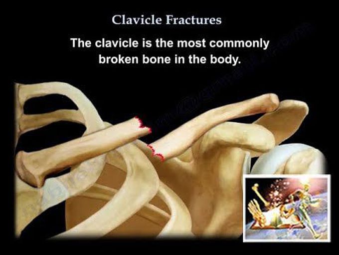 Clavicle Fractures  - Everything You Need To Know - Dr. Nabil Ebraheim