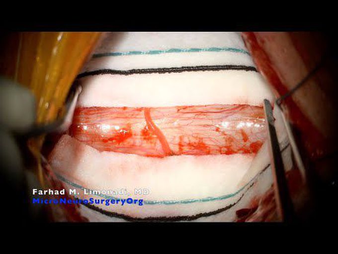 Spinal syrinx and disseminated coccidioidomycosis. Surgical management. Syringo-subarachnoid Shunt.