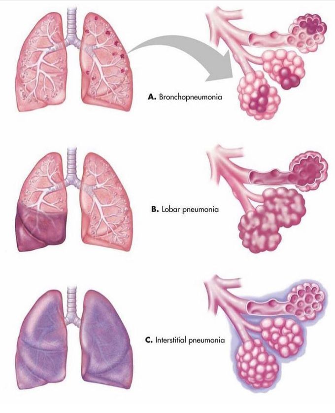 Different Types of pneumoniae