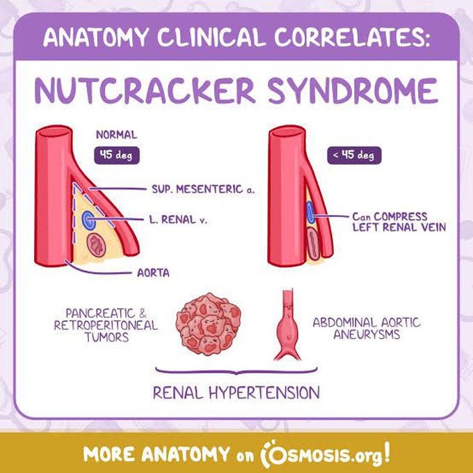 Nutcracker Syndrome