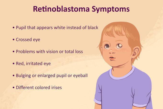 Retinoblastoma eye signs