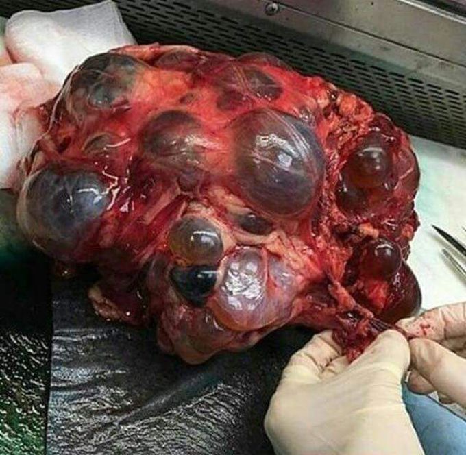 Polycystic kidney disease.
This kidney weighs 4.5kg.!!