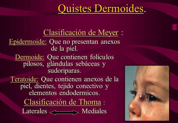 Tumores benignos
