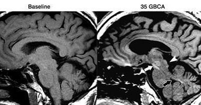 Study finds gadolinium hot spots from MRI contrast, but no clinical effects
