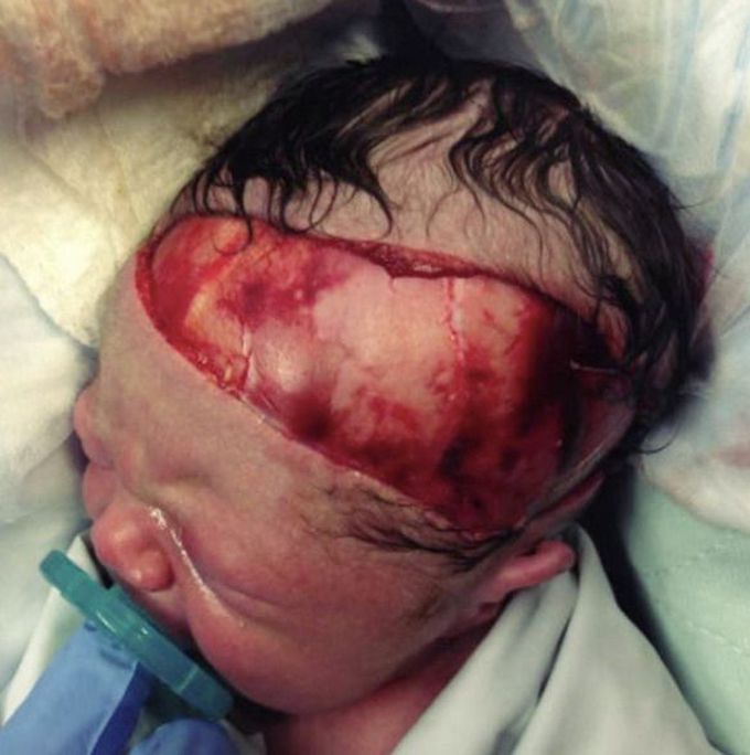 Severe scalp laceration 
