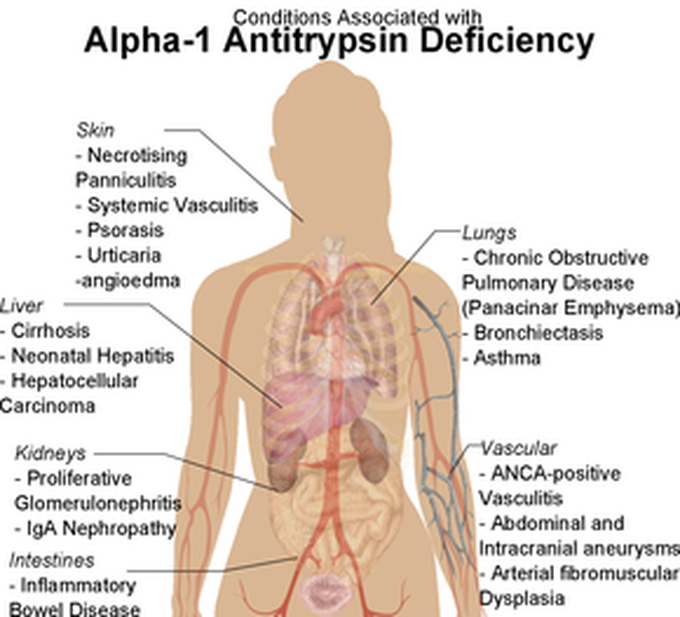 Symptoms of Alpha-1 Antitrypsin deficiency