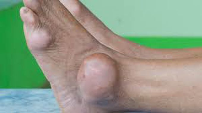 Gout symptoms