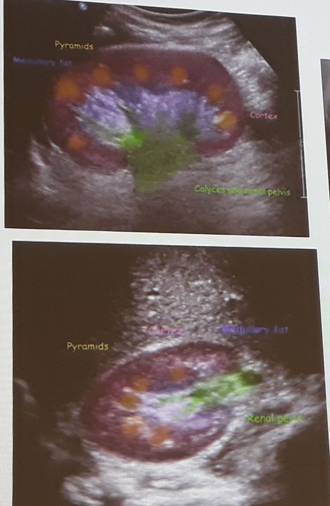 Kidney ultrasonography