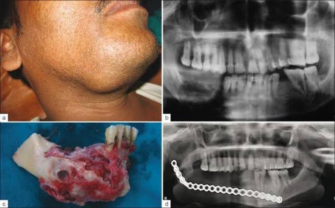 Ameloblastoma