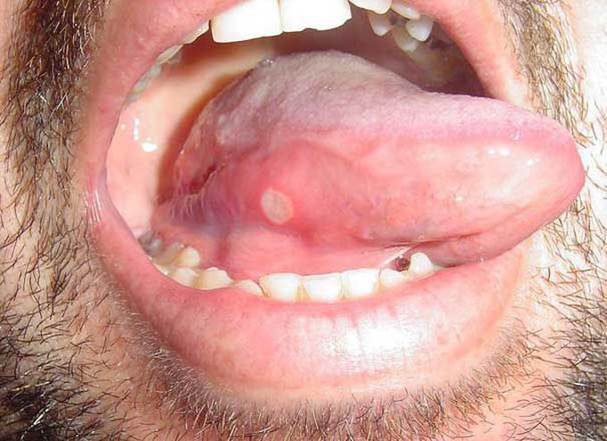 What's the name of this oral sign?!!and in which disease we see it ?!