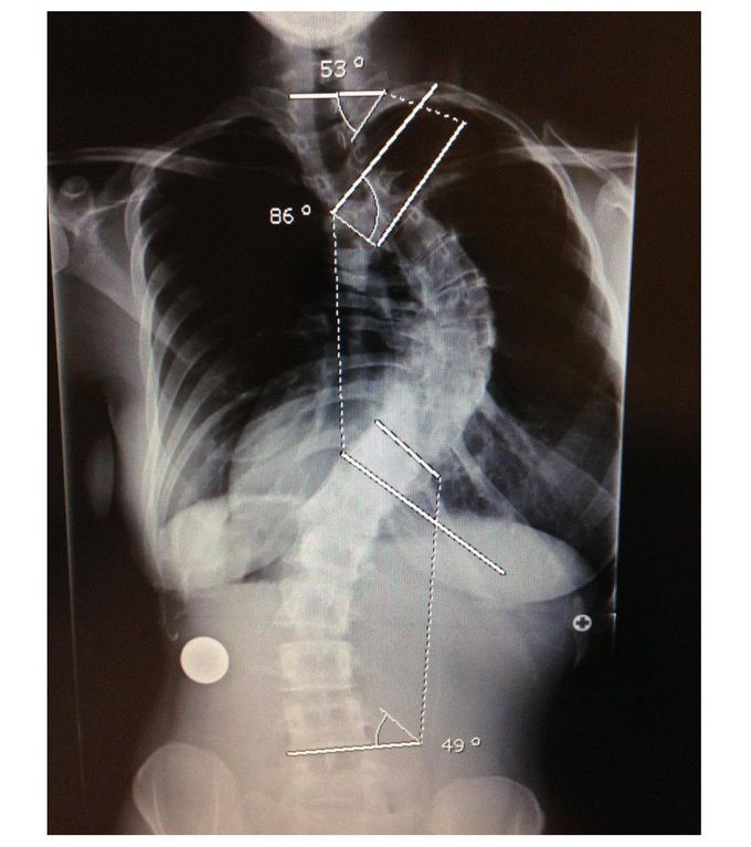 Scoliosis 📋